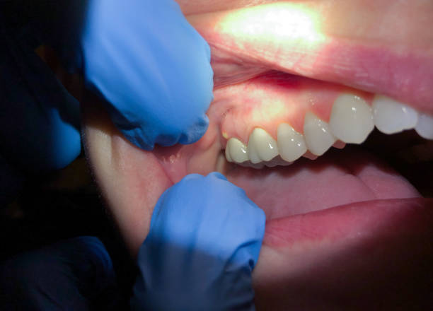 Emergency Dental Filling Replacement in CT